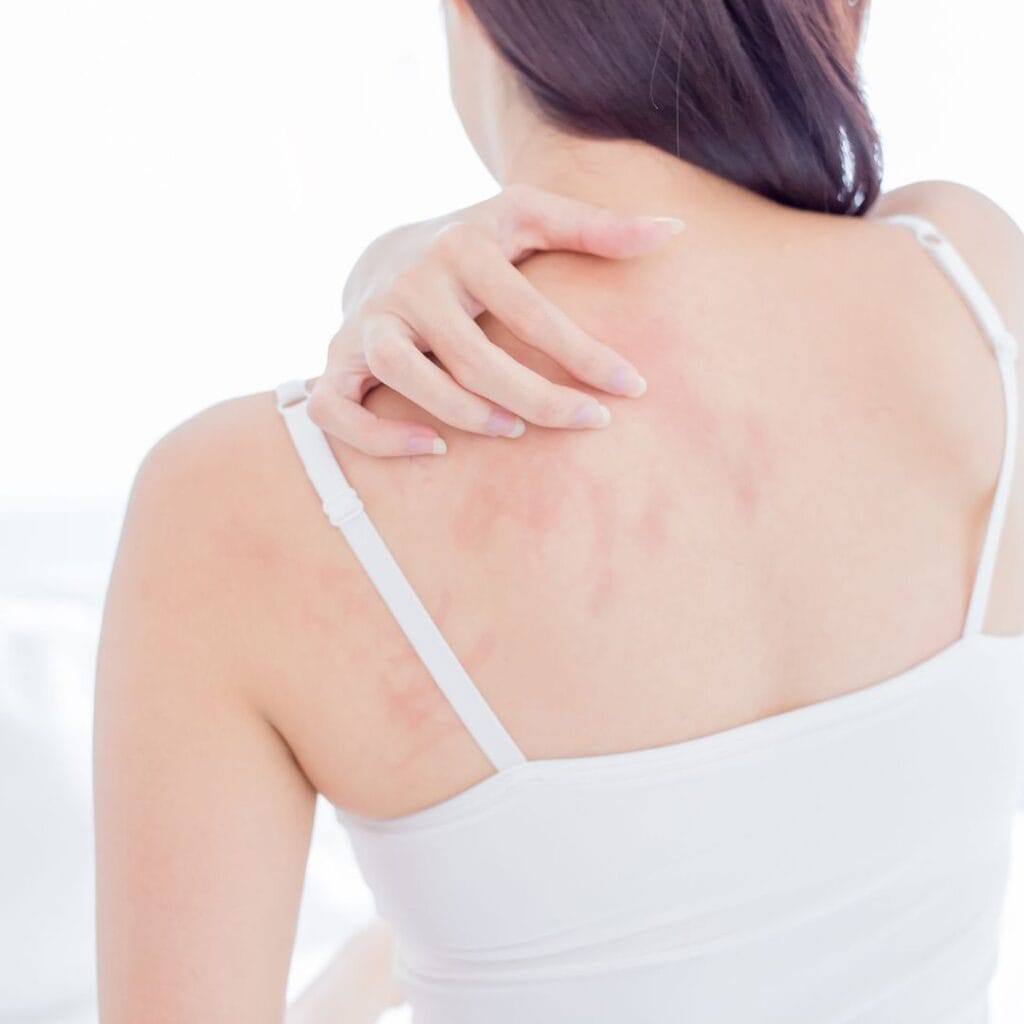 woman in white tank top scratching her back and leaving red marks